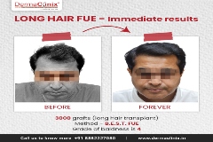 Long hair FUE transplant results