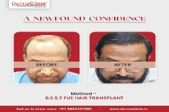 vip hair transplant in delhi