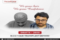 vip hair transplant results dr amrendra kumar
