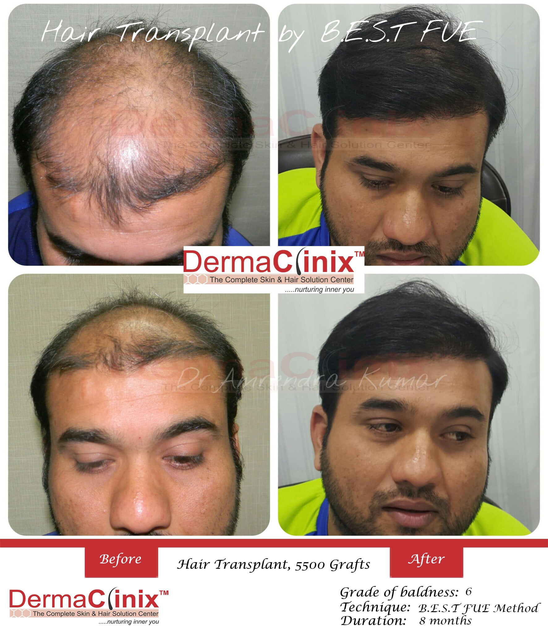 hair transplant surgery in india