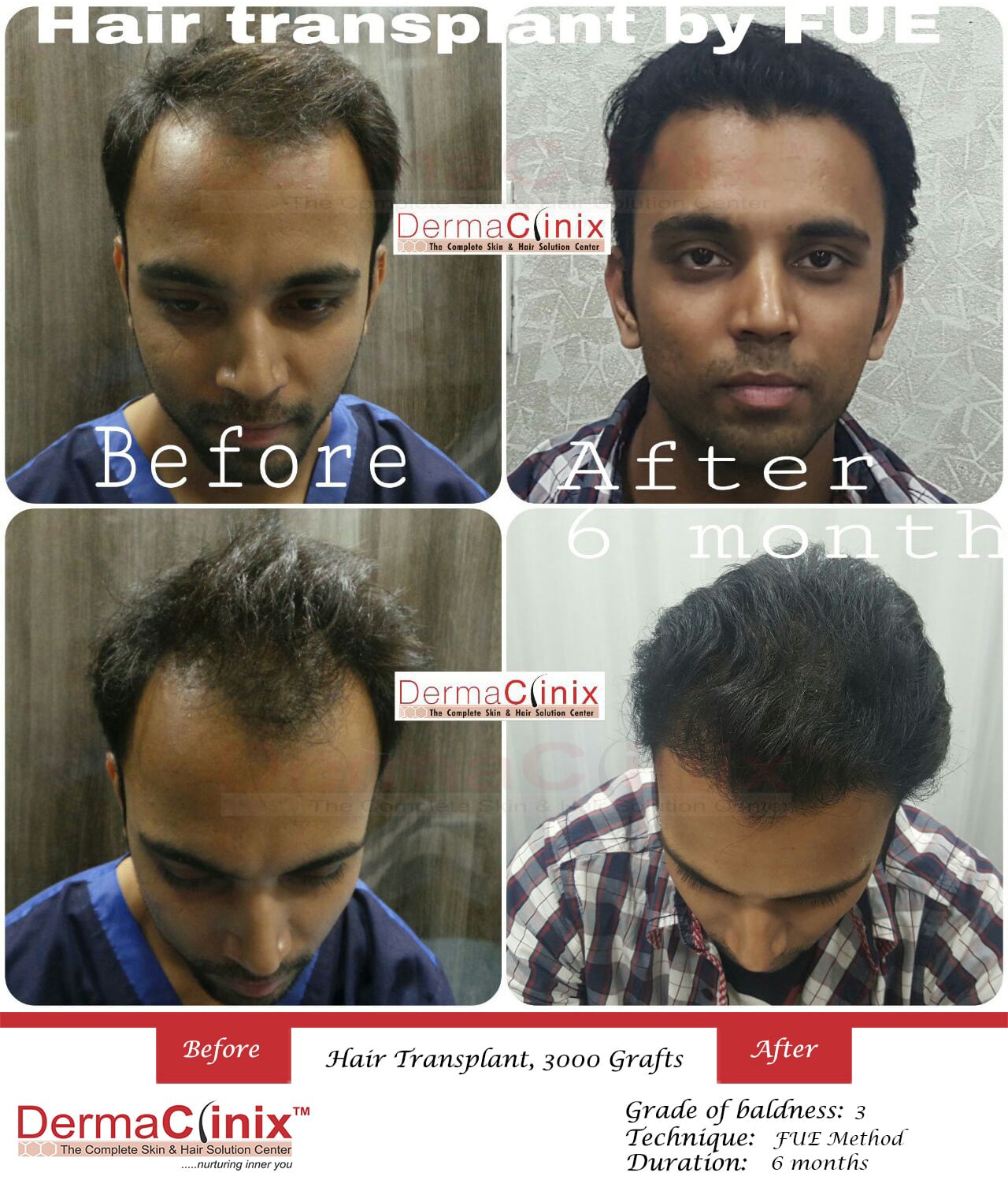 Hair Transplant Surgery PRP ResultsBefore And After Photos
