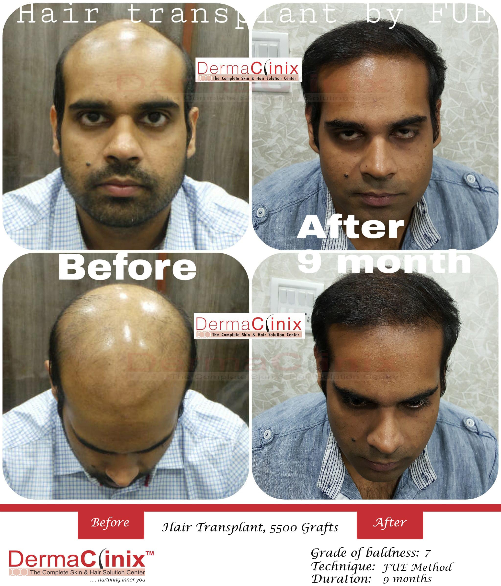 Hair Transplant Surgery PRP ResultsBefore And After Photos