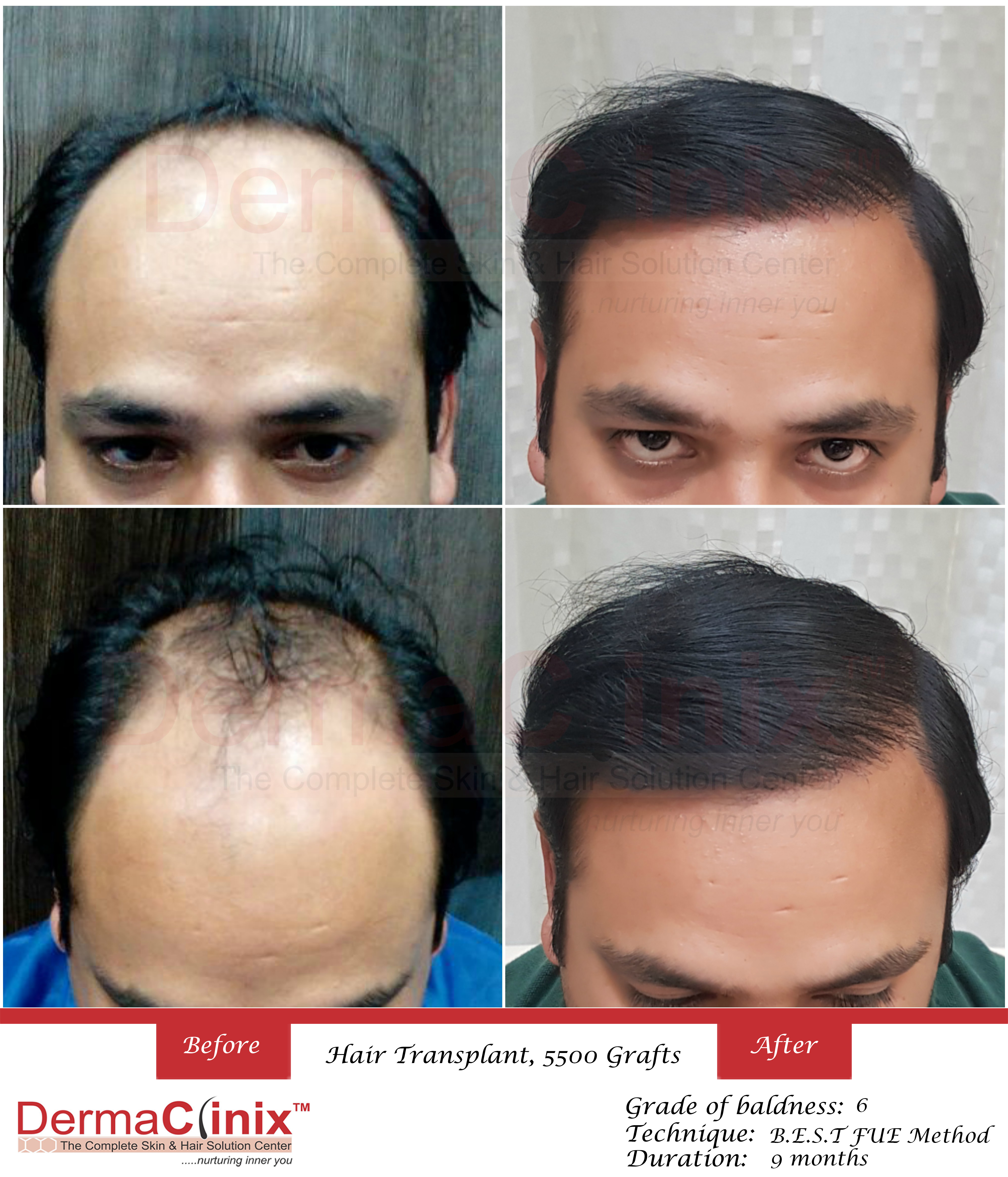 Best FUE Hair Transplant Results - DermaClinix New Delhi.