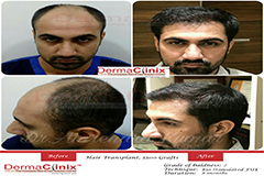 Hair Transplant Surgery & PRP Results, Before and After Photos India