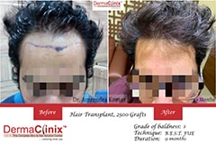 9 months hair transplant dermaclinix