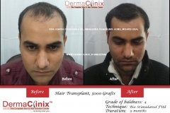 Hair-Transplant-Result-16