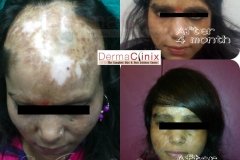 acid-burn-scar-hair-transplant-result-14
