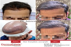 before after hair transplant India