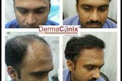 best hair transplant in south delhi