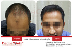 hair transplant results Delhi India