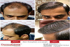 best hair transplant results India