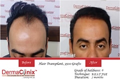 brazilian hair transplant before after