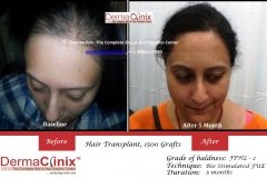 female-fue-hair-transplant-result-52