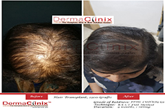 female hair transplant result Delhi