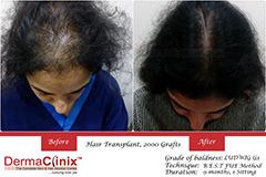 female hair transplant results in Delhi