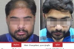 fue-hair-transplant-result-17