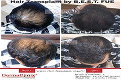 full vertex hair transplant results India