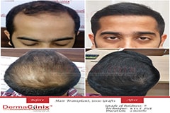 hair restoration surgery results