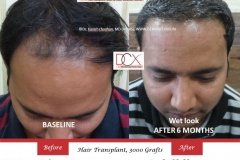 hair-transplant-before-after-43