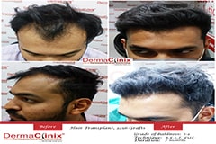 hair transplant before after Delhi