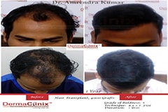 hairtransplantresultsindia