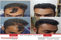 hair transplant in delhi Review
