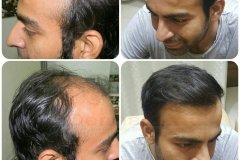 hair-transplant-result-14