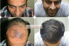 hair-transplant-result-15