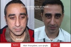 hair-transplant-result-18