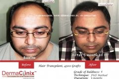 hair-transplant-result-19