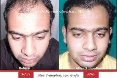 hair transplant in west delhi