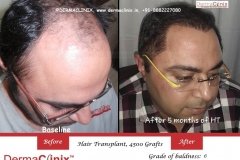 hair-transplant-result-20