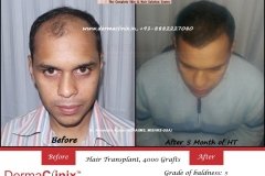 hair-transplant-result-21