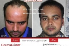hair-transplant-result-24