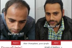 hair transplantation result delhi