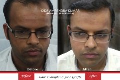 hair-transplant-result-35