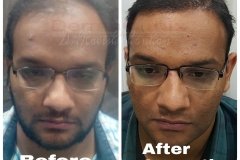hair-transplant-result-38