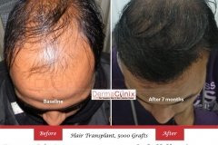 hair-transplant-result-44