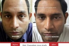 hair-transplant-result-48