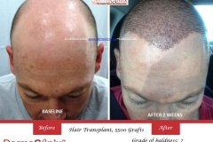 hair-transplant-result-49