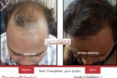 hair restoration result