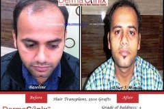 hair-transplant-result-50