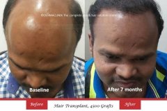 hair-transplant-result-53