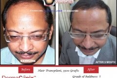 hair-transplant-result-54