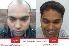 hair-transplant-result-56