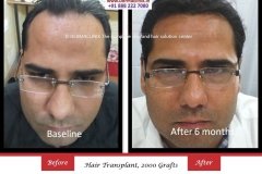 hair-transplant-result-57
