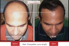 hair-transplant-result-61