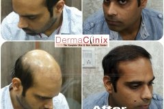 hair plantation results