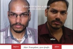 hair transplant result india