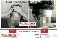 hair transplant result by BEST